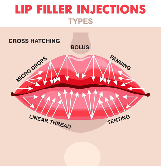 Facial Fillers